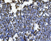 IHC staining of FFPE human lung cancer tissue with SUB1 antibody. HIER: boil tissue sections in pH8 EDTA for 20 min and allow to cool before testing.