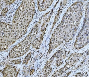 IHC staining of FFPE human liver cancer tissue with SUB1 antibody. HIER: boil tissue sections in pH8 EDTA for 20 min and allow to cool before testing.