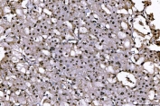 IHC staining of FFPE human renal cell carcinoma tissue with SUB1 antibody. HIER: boil tissue sections in pH8 EDTA for 20 min and allow to cool before testing.