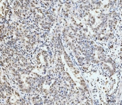 IHC staining of FFPE human metaplasia of squamous cells of the renal pelvis tissue with p53 binding protein 1 antibody. HIER: boil tissue sections in pH8 EDTA for 20 min and allow to cool before testing.