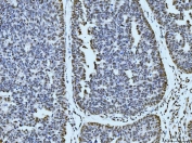 IHC staining of FFPE human bladder epithelial carcinoma tissue with p53 binding protein 1 antibody. HIER: boil tissue sections in pH8 EDTA for 20 min and allow to cool before testing.