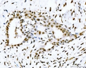 IHC staining of FFPE human breast cancer tissue with p53 binding protein 1 antibody. HIER: boil tissue sections in pH8 EDTA for 20 min and allow to cool before testing.