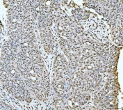 IHC staining of FFPE human ovarian cancer tissue with p53 binding protein 1 antibody. HIER: boil tissue sections in pH8 EDTA for 20 min and allow to cool before testing.
