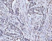 IHC staining of FFPE human lung cancer tissue with p53 binding protein 1 antibody. HIER: boil tissue sections in pH8 EDTA for 20 min and allow to cool before testing.