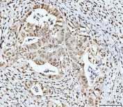 IHC staining of FFPE human moderately differentiated rectal adenocarcinoma tissue with p53 binding protein 1 antibody. HIER: boil tissue sections in pH8 EDTA for 20 min and allow to cool before testing.