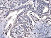 IHC staining of FFPE human colorectal cancer tissue with TPR antibody. HIER: boil tissue sections in pH8 EDTA for 20 min and allow to cool before testing.