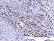 IHC staining of FFPE human laryngeal squamous cell carcinoma tissue with Yin and yang 1 antibody. HIER: boil tissue sections in pH8 EDTA for 20 min and allow to cool before testing.