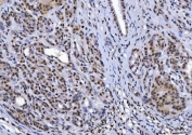 IHC staining of FFPE human pancreatic ductal adenocarcinoma tissue with YY1 antibody. HIER: boil tissue sections in pH8 EDTA for 20 min and allow to cool before testing.