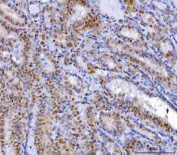 IHC staining of FFPE human thyroid cancer tissue with YY1 antibody. HIER: boil tissue sections in pH8 EDTA for 20 min and allow to cool before testing.