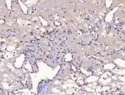 IHC staining of FFPE human renal clear cell carcinoma tissue with YY1 antibody. HIER: boil tissue sections in pH8 EDTA for 20 min and allow to cool before testing.