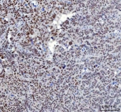 IHC staining of FFPE human ovarian serous cancer tissue with YY1 antibody. HIER: boil tissue sections in pH8 EDTA for 20 min and allow to cool before testing.
