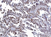 IHC staining of FFPE human serous adenocarcinoma of the ovary tissue with YY1 antibody. HIER: boil tissue sections in pH8 EDTA for 20 min and allow to cool before testing.