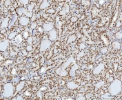 IHC staining of FFPE human thyroid cancer tissue with YY1 antibody. HIER: boil tissue sections in pH8 EDTA for 20 min and allow to cool before testing.