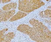 IHC staining of FFPE human laryngeal squamous cell carcinoma tissue with YY1 antibody. HIER: boil tissue sections in pH8 EDTA for 20 min and allow to cool before testing.