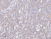 IHC staining of FFPE human lymphoma tissue with PLP2 antibody. HIER: boil tissue sections in pH8 EDTA for 20 min and allow to cool before testing.