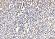 IHC staining of FFPE human liver cancer tissue with PLP2 antibody. HIER: boil tissue sections in pH8 EDTA for 20 min and allow to cool before testing.