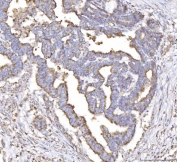 IHC staining of FFPE human cervical cancer tissue with PLP2 antibody. HIER: boil tissue sections in pH8 EDTA for 20 min and allow to cool before testing.