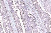 IHC staining of FFPE human adenocarcinoma of the right colon tissue with PLP2 antibody. HIER: boil tissue sections in pH8 EDTA for 20 min and allow to cool before testing.