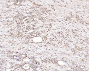 IHC staining of FFPE human gastric carcinoma tissue with PLP2 antibody. HIER: boil tissue sections in pH8 EDTA for 20 min and allow to cool before testing.