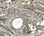 IHC staining of FFPE human cervical cancer tissue with APLN antibody. HIER: boil tissue sections in pH8 EDTA for 20 min and allow to cool before testing.