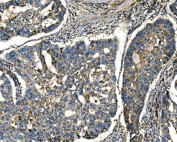 IHC staining of FFPE human adenocarcinoma of the right colon tissue with APLN antibody. HIER: boil tissue sections in pH8 EDTA for 20 min and allow to cool before testing.