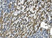 IHC staining of FFPE human liver cancer tissue with APLN antibody. HIER: boil tissue sections in pH8 EDTA for 20 min and allow to cool before testing.