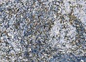 IHC staining of FFPE human lung cancer tissue with APLN antibody. HIER: boil tissue sections in pH8 EDTA for 20 min and allow to cool before testing.