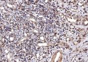 IHC staining of FFPE human laryngeal squamous cell carcinoma tissue with COX4I1 antibody. HIER: boil tissue sections in pH8 EDTA for 20 min and allow to cool before testing.