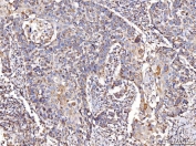 IHC staining of FFPE human bladder epithelial carcinoma tissue with COX4I1 antibody. HIER: boil tissue sections in pH8 EDTA for 20 min and allow to cool before testing.