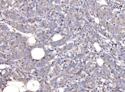 IHC staining of FFPE human endometrial cancer tissue with COX4I1 antibody. HIER: boil tissue sections in pH8 EDTA for 20 min and allow to cool before testing.