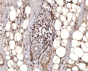 IHC staining of FFPE human liver cancer tissue with COX4I1 antibody. HIER: boil tissue sections in pH8 EDTA for 20 min and allow to cool before testing.