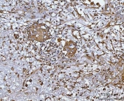 IHC staining of FFPE human breast cancer tissue with CCL14 antibody. HIER: boil tissue sections in pH8 EDTA for 20 min and allow to cool before testing.