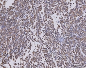 IHC staining of FFPE human liver cancer tissue with CCL14 antibody. HIER: boil tissue sections in pH8 EDTA for 20 min and allow to cool before testing.