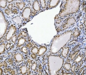IHC staining of FFPE human thyroiditis tissue with Homeobox protein cut-like 1 antibody. HIER: boil tissue sections in pH8 EDTA for 20 min and allow to cool before testing.