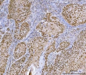 IHC staining of FFPE human laryngeal squamous cell carcinoma tissue with Homeobox protein cut-like 1 antibody. HIER: boil tissue sections in pH8 EDTA for 20 min and allow to cool before testing.