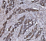 IHC staining of FFPE human colonic adenocarcinoma tissue with Junctional adhesion molecule A antibody. HIER: boil tissue sections in pH8 EDTA for 20 min and allow to cool before testing.