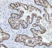 IHC staining of FFPE human colonic adenocarcinoma tissue with Junctional adhesion molecule A antibody. HIER: boil tissue sections in pH8 EDTA for 20 min and allow to cool before testing.