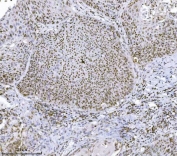 IHC staining of FFPE human laryngeal squamous cell carcinoma tissue with JHDM3A antibody. HIER: boil tissue sections in pH8 EDTA for 20 min and allow to cool before testing.