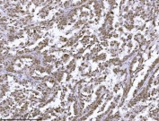 IHC staining of FFPE human ovarian serous carcinoma tissue with JHDM3A antibody. HIER: boil tissue sections in pH8 EDTA for 20 min and allow to cool before testing.