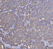 IHC staining of FFPE human ovarian carcinoma tissue with MUC1 antibody. HIER: boil tissue sections in pH8 EDTA for 20 min and allow to cool before testing.