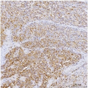 IHC staining of FFPE human melanoma tissue with PPP1R15A antibody. HIER: boil tissue sections in pH8 EDTA for 20 min and allow to cool before testing.