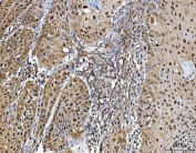 IHC staining of FFPE human laryngeal squamous cell carcinoma tissue with Protein arginine N-methyltransferase 5 antibody. HIER: boil tissue sections in pH8 EDTA for 20 min and allow to cool before testing.