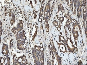 IHC staining of FFPE human rectum adenocarcinoma tissue with RGS12 antibody. HIER: boil tissue sections in pH8 EDTA for 20 min and allow to cool before testing.