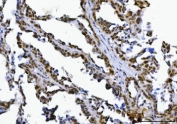 IHC staining of FFPE human ovarian serous carcinoma tissue with SPT5 antibody. HIER: boil tissue sections in pH8 EDTA for 20 min and allow to cool before testing.