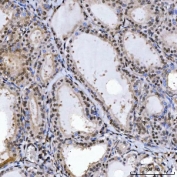 IHC staining of FFPE human thyroiditis tissue with SPT5 antibody. HIER: boil tissue sections in pH8 EDTA for 20 min and allow to cool before testing.