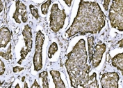 IHC staining of FFPE human breast cancer tissue with NDFIP2 antibody. HIER: boil tissue sections in pH8 EDTA for 20 min and allow to cool before testing.