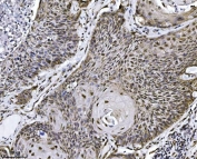 IHC staining of FFPE human squamous cell lung carcinoma tissue with NDFIP2 antibody. HIER: boil tissue sections in pH8 EDTA for 20 min and allow to cool before testing.