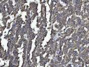 IHC staining of FFPE human ovarian serous carcinoma tissue with DBN1 antibody. HIER: boil tissue sections in pH8 EDTA for 20 min and allow to cool before testing.