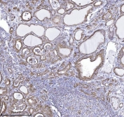 IHC staining of FFPE human thyroid cancer tissue with DBN1 antibody. HIER: boil tissue sections in pH8 EDTA for 20 min and allow to cool before testing.