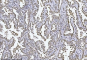 IHC staining of FFPE human adenocarcinoma of the lung tissue with PMPCB antibody. HIER: boil tissue sections in pH8 EDTA for 20 min and allow to cool before testing.
